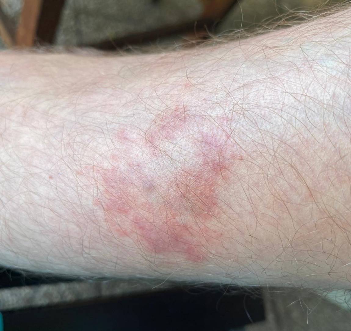 Netypický červený flek po klíštěti. Může jít o lymeskou boreliózu?