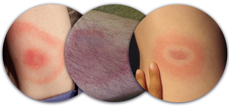 Lymeská borelioza - červené skvrny, zarudnuté fleky na kůži
